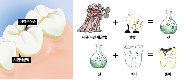치아우식증(충치)