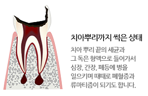 치아우식증(충치) 치아뿌리까지 썩은 상태