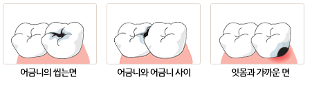 치아우식증(충치)이 잘 생기는 부위