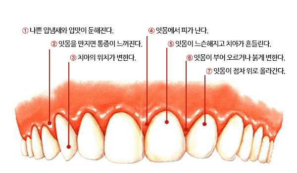 치주질환의 자가진단