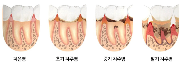 치주질환(잇몸병)의 진행과정